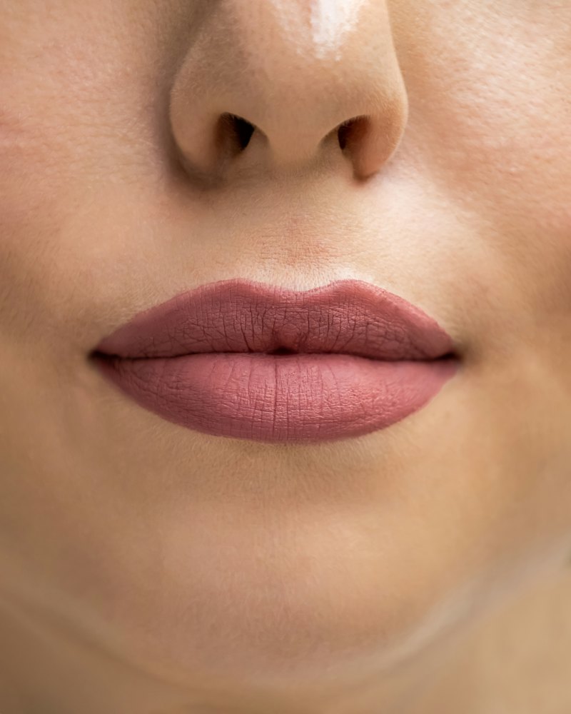 Ácido hialurónico en labios
